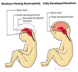 A drawing comparing a baby with anencephay to a one without the condition.