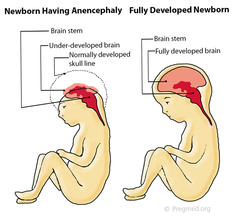 Anencephaly - Fetal Health Foundation