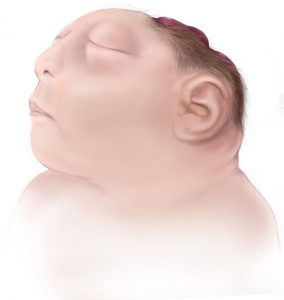 Illustration of a baby with anencephaly