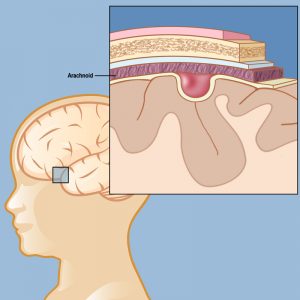 arachnoid cyst illustration