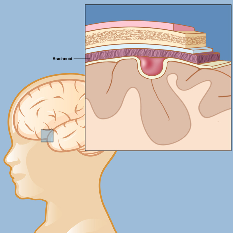 Arachnoid-cyst-pediatric-lg