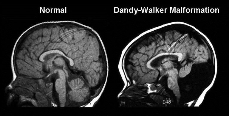 Dandy-Walker brain image via Fetal Health Foundation