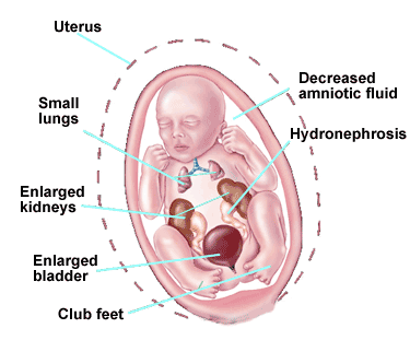 Lower Urinary Tract Obstruction: Diagnosis & Treatment