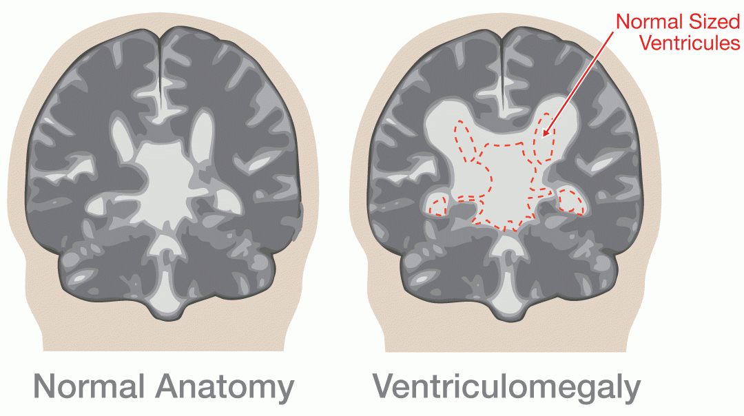 Ventriculomegaly