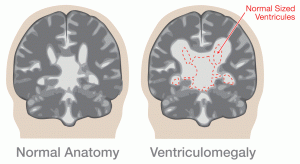 Ventriculomegaly