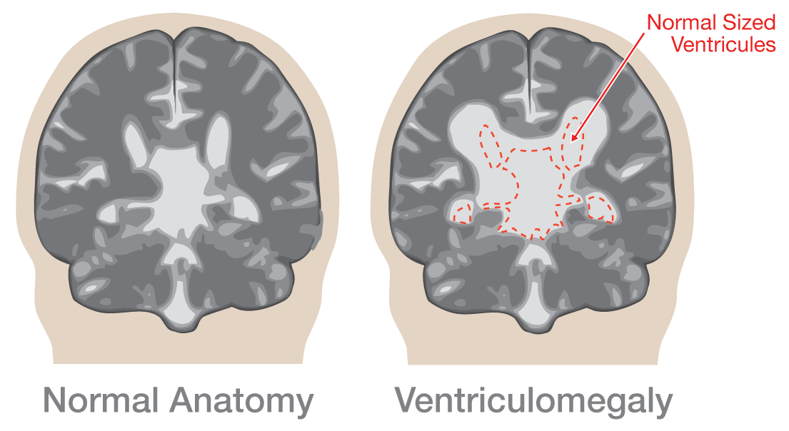 Learn about a Ventriculomegaly Diagnosis during Pregnancy