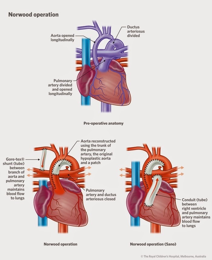 An illustration of Hypoplastic left heart syndrome