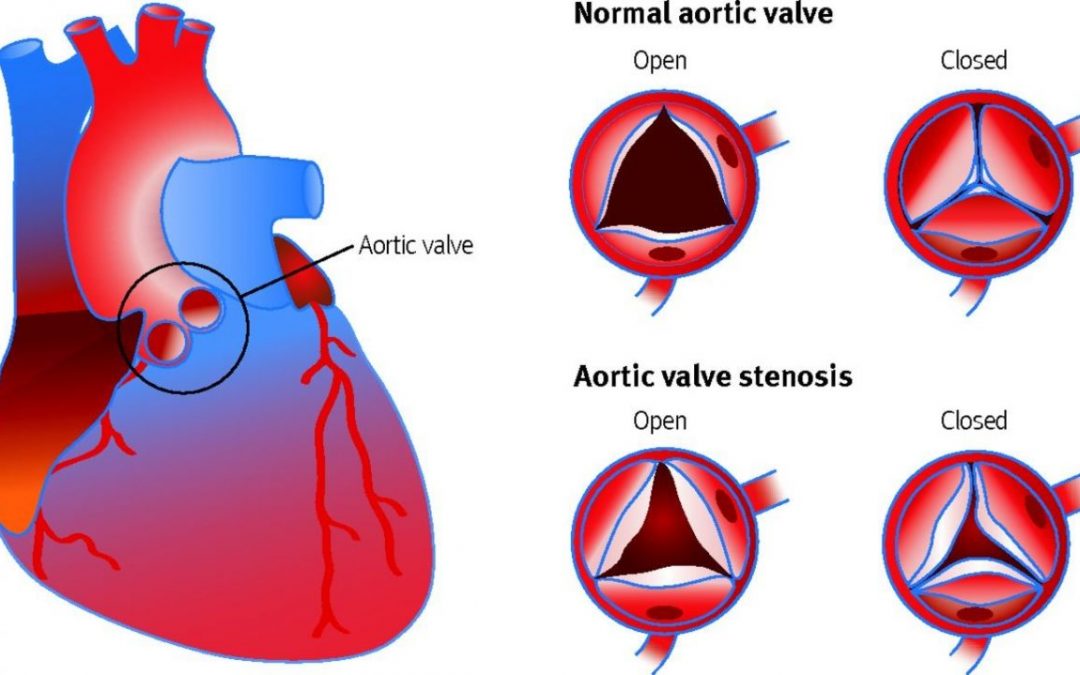 Aortic Stenosis