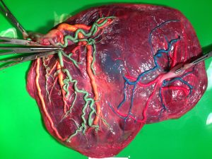  Twin Anemia Polycythemia Sequence placenta photo