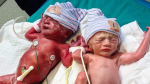  Twin Anemia Polycythemia Sequence (TAP) babies