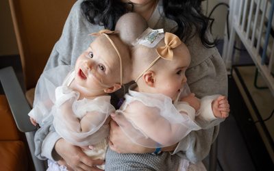 Conjoined twins get life-saving care at UC Davis Health