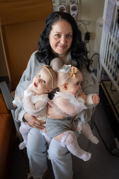 Conjoined twins get life-saving care at UC Davis Health