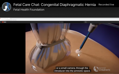 Congenital Diaphragmatic Hernia (CDH): Fetal Care Chat