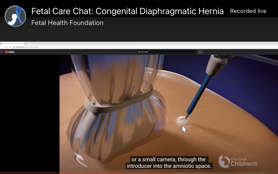 Congenital Diaphragmatic Hernia (CDH): Fetal Care Chat
