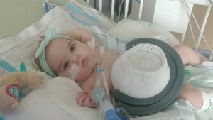 An alert infant patient with a light green bow headband being treated for a giant omphalocele looks at the camera.