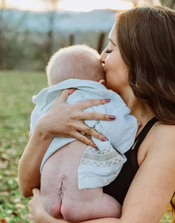 Mom snuggles baby with surgery scar visible at the base of his spine