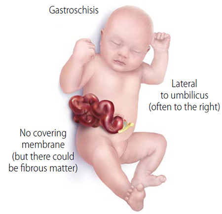 Gastroschisis and the search for better, earlier interventions﻿ at UC Davis Health